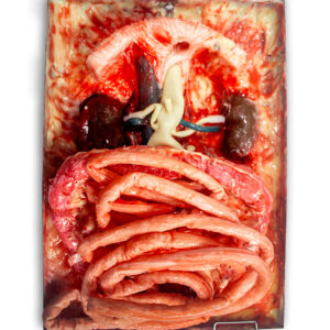 AAA Simulator with Lifelike Aortic Aneurysm Model