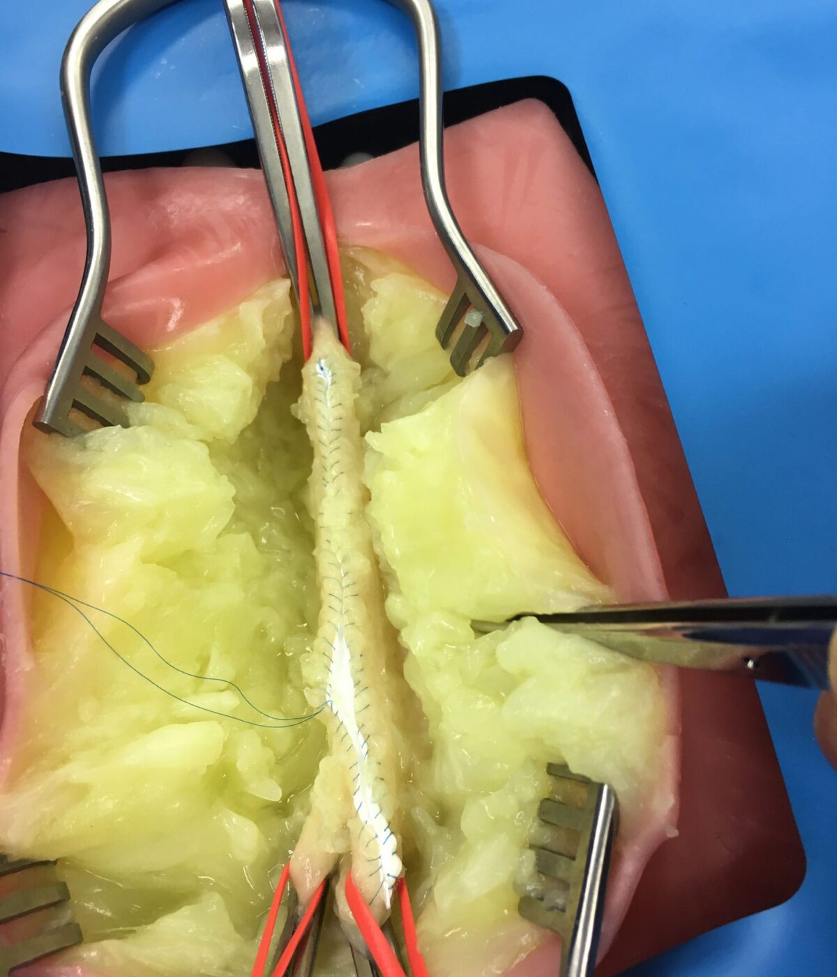 VI Box Surgery 2