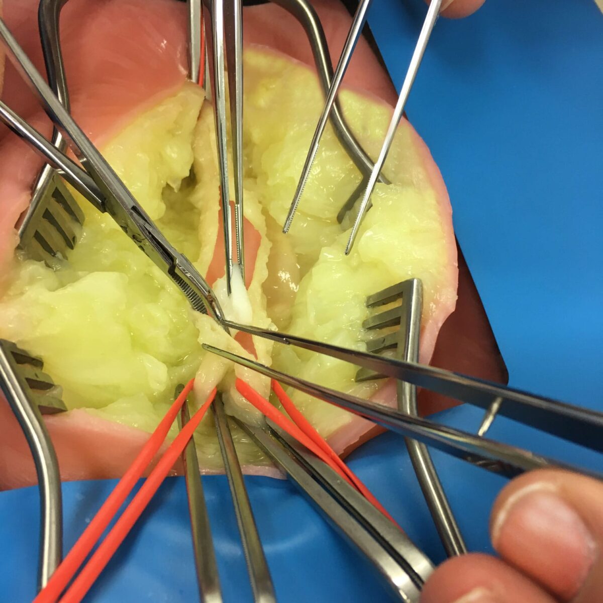 Femoral Groin Endarterectomy