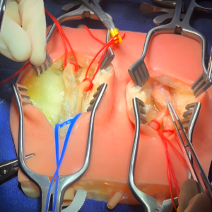 VI Embedded Carotid Arteries with Plaque and Dermis Model - Image 4