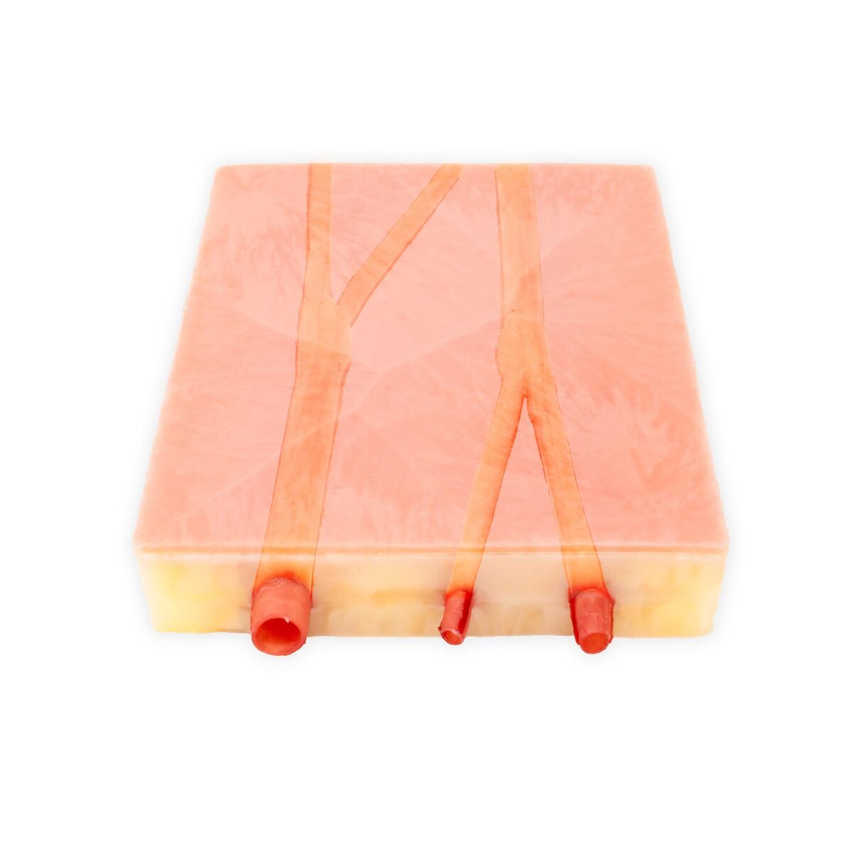 Embedded Carotids with plaque